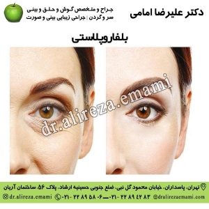 بلفاروپلاستی