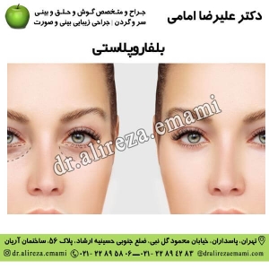 بلفاروپلاستی