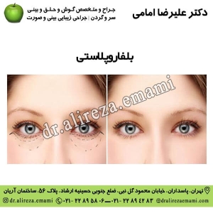 بلفاروپلاستی