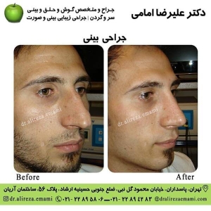 جراحی بینی