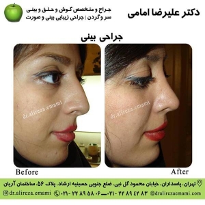 جراحی بینی