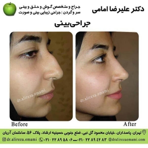 جراحی بینی