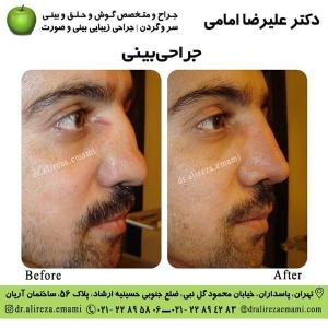 جراحی بینی