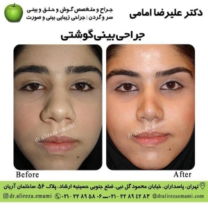جراحی بینی