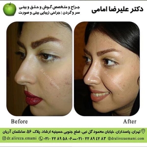 جراحی بینی