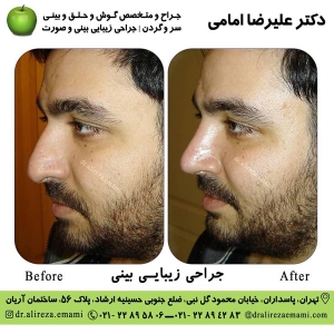 جراحی بينی طبيعی