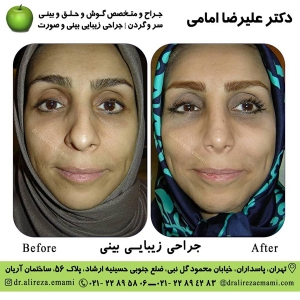 جراحی بينی طبيعی