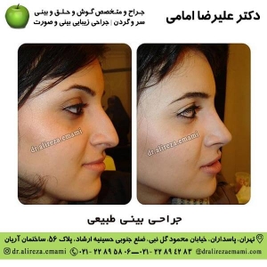 جراحی بينی طبيعی