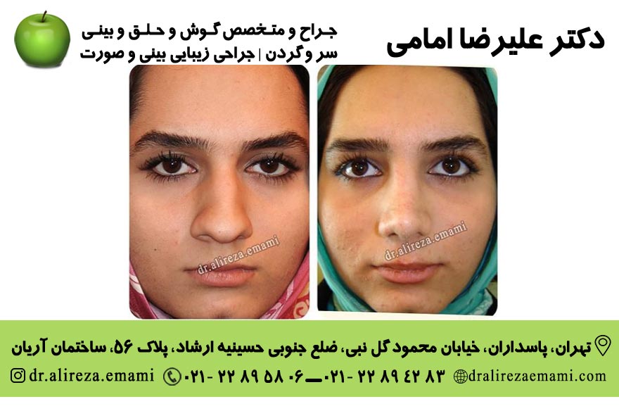 جراحی بینی گوشتی