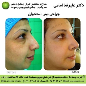 جراحی بینی استخوانی