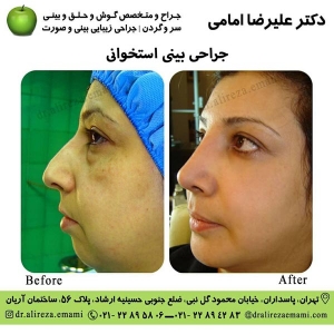 جراحی بینی استخوانی