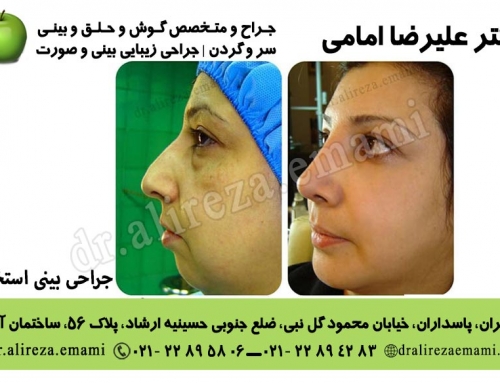 جراحی بینی استخوانی