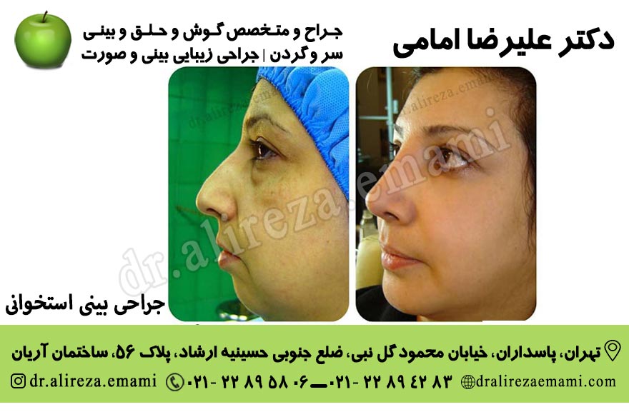 جراحی بینی استخوانی