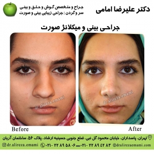 جراحی بینی گوشتی