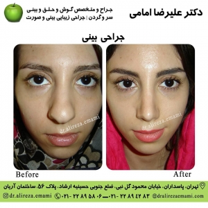 جراحی بینی گوشتی