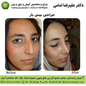 جراحی بینی باز