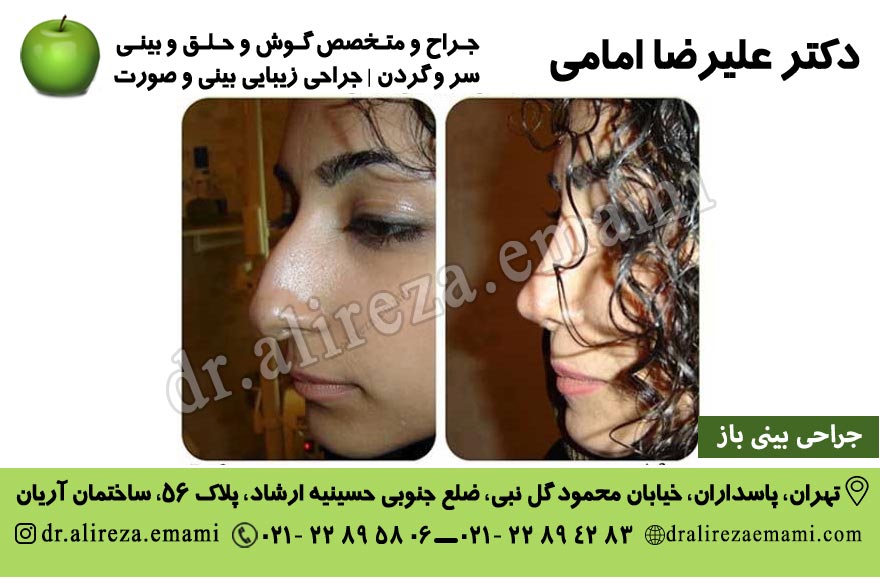 جراحی بینی باز