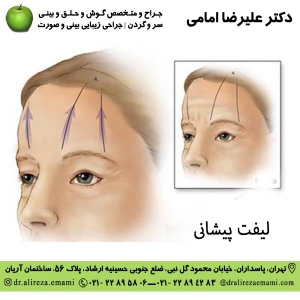 لیفت پیشانی