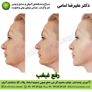 رفع غبغب