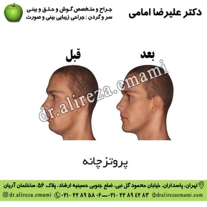 پروتز چانه