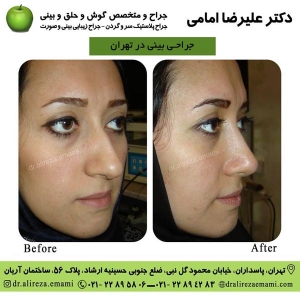 جراحی بینی در تهران