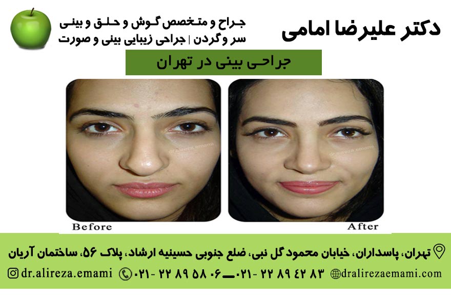 جراحی بینی در تهران