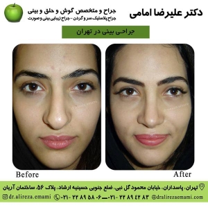 جراحی بینی در تهران