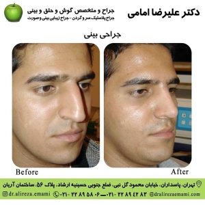 جراحی بینی بسته