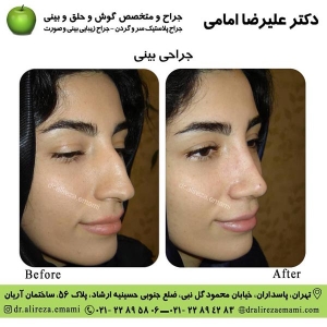 جراحی بینی بسته