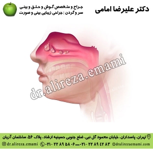 پولیپ بینی