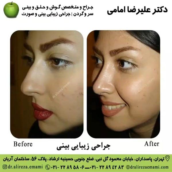 جراحی بینی تهران