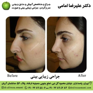 جراحی بینی استخوانی
