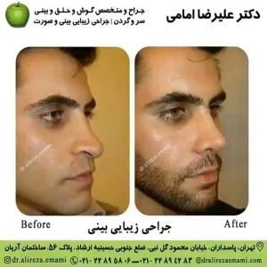 جراحی بینی بسته